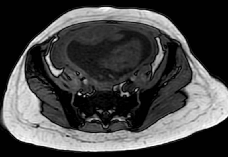 File:Appendicitis in gravida (MRI) (Radiopaedia 89433-106395 D 51).jpg