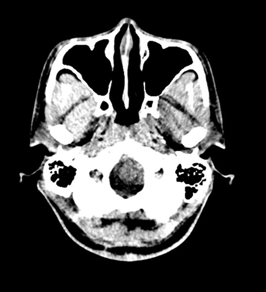 File:Arachnoid cyst of the ambient cistern (Radiopaedia 81301-94986 Axial non-contrast 6).jpg