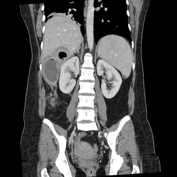 File:Ascending retrocecal appendicitis with liver abscesses (Radiopaedia 60066-67615 C 12).jpg
