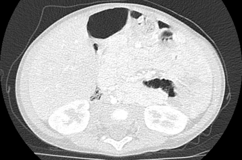 File:Asplenia syndrome (Radiopaedia 73083-83792 Axial lung window 99).jpg