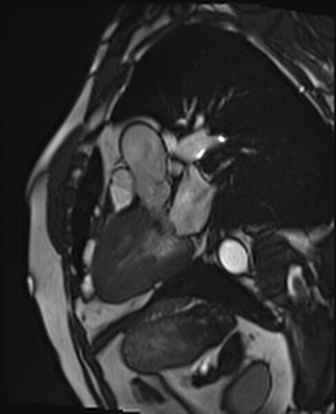 File:Asymmetric septal hypertrophic cardiomyopathy - systolic anterior motion of mitral leaflet (Radiopaedia 72795-83445 B 6).jpg