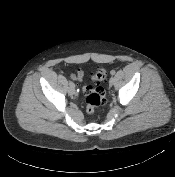 File:Atrophic kidney due to severe chronic obstructive hydronephrosis (Radiopaedia 40828-43474 Axial non-contrast 39).jpg