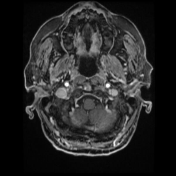 File:Atypical meningioma (Radiopaedia 45535-49629 Axial T1 C+ 17).jpg