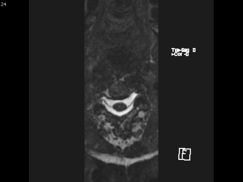 File:Atypical meningioma - intraosseous (Radiopaedia 64915-74572 Axial CISS 24).jpg