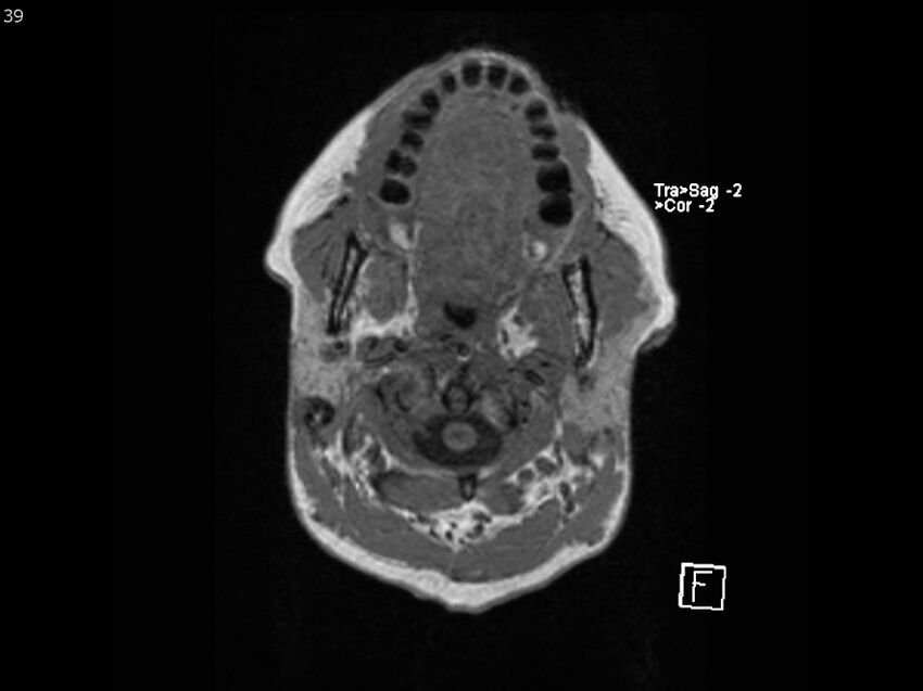 Atypical meningioma - intraosseous (Radiopaedia 64915-74572 Axial T1 39).jpg