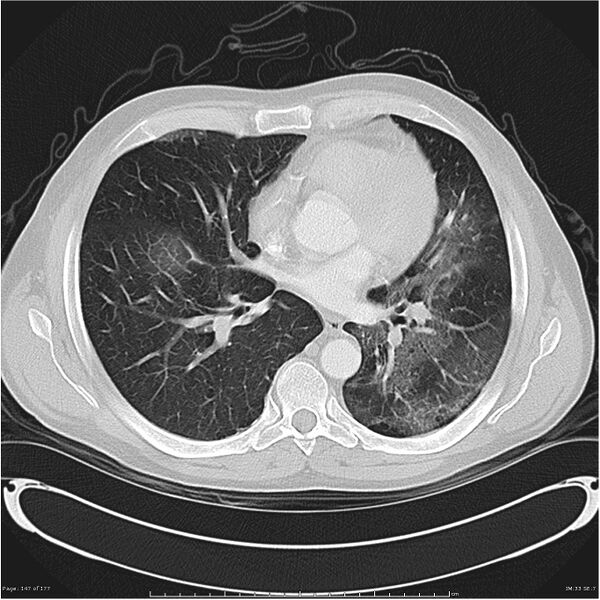 File:Atypical pneumonia - Q fever (Radiopaedia 21993-21989 lung window 26).jpg