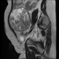 Atypical retroperitoneal lymphocoeles with large leiomyoma of uterus (Radiopaedia 32084-33027 Sagittal T2 25).jpg