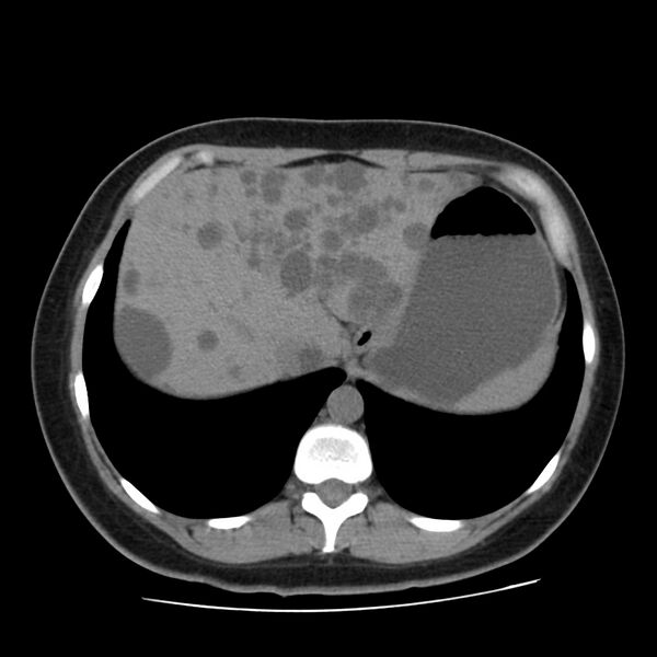File:Autosomal dominant polycystic kidney disease (Radiopaedia 23061-23093 Axial non-contrast 10).jpg