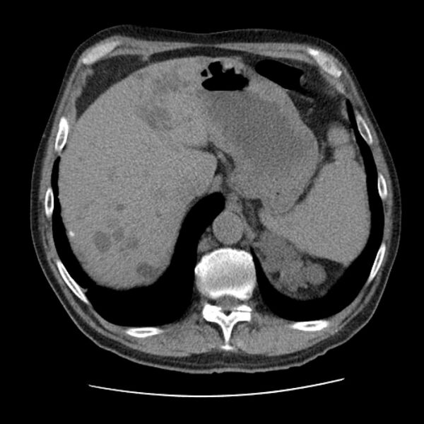 File:Autosomal dominant polycystic kidney disease (Radiopaedia 27851-28094 Axial non-contrast 51).jpg