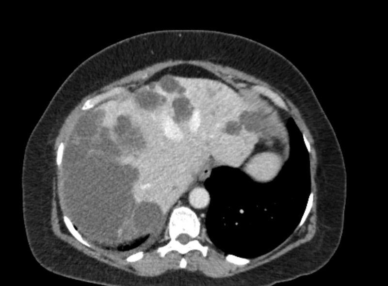 File:Autosomal dominant polycystic kidney disease (Radiopaedia 57124-64017 A 24).jpg