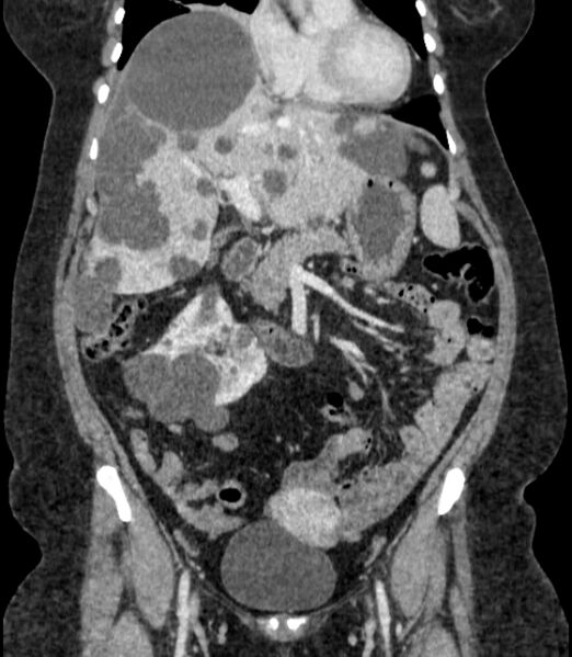 File:Autosomal dominant polycystic kidney disease (Radiopaedia 57124-64017 B 30).jpg