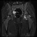 Avascular necrosis of the hip (Radiopaedia 29563-30067 Coronal T2 fat sat 10).jpg