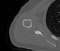 Avulsion fracture - greater tuberosity of humerus (Radiopaedia 71216-81514 Axial bone window 53).jpg