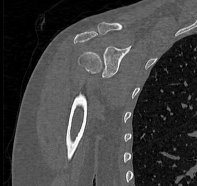 File:Avulsion fracture - greater tuberosity of humerus (Radiopaedia 71216-81514 Coronal bone window 33).jpg