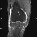 Avulsion fracture of the fibular head (Radiopaedia 74804-85808 Coronal PD fat sat 13).jpg
