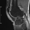 Avulsion fracture of the fibular head (Radiopaedia 74804-85808 Sagittal PD fat sat 26).jpg