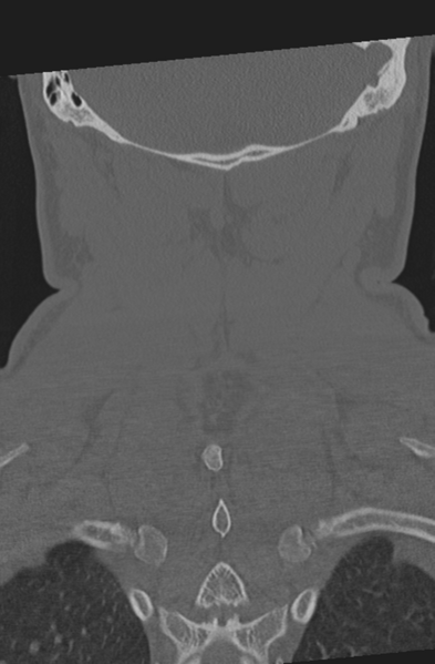 File:Axis peg fracture (type 3) and atlas lateral mass (type 4) fracture (Radiopaedia 37474-39324 Coronal bone window 52).png