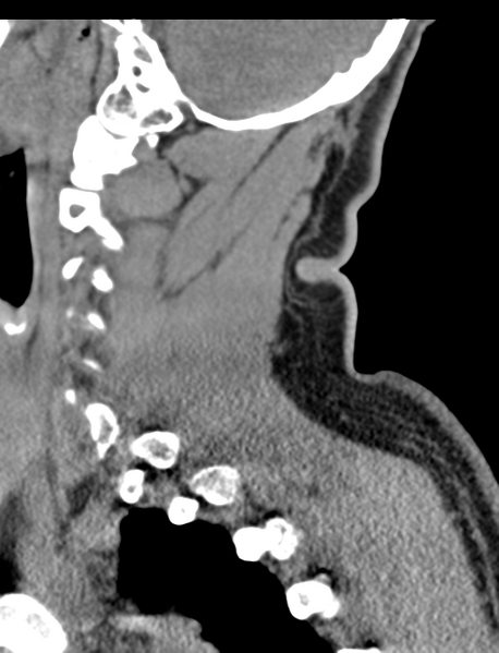 File:Axis peg fracture (type 3) and atlas lateral mass (type 4) fracture (Radiopaedia 37474-39324 D 21).png