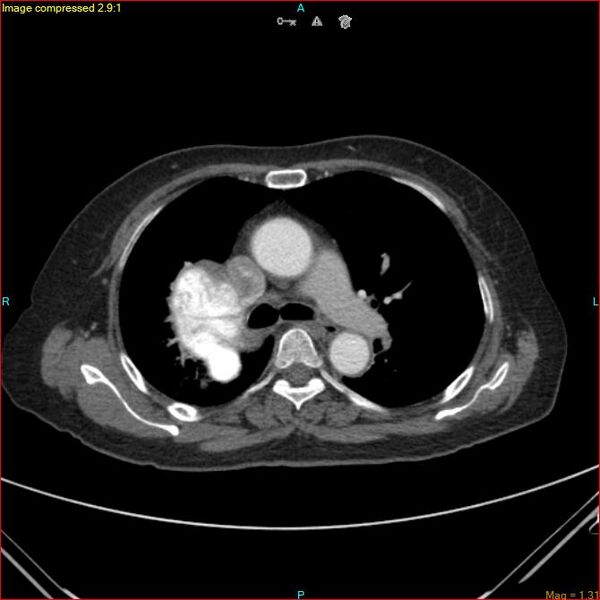 File:Azygos vein aneurysm (Radiopaedia 77824-90130 B 26).jpg
