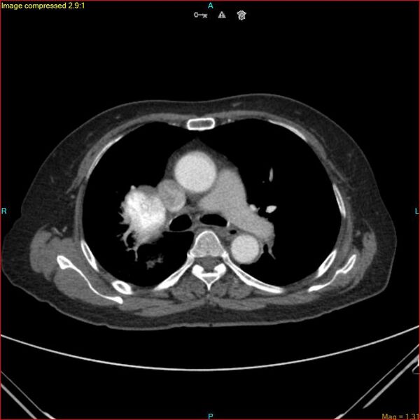 File:Azygos vein aneurysm (Radiopaedia 77824-90130 B 27).jpg