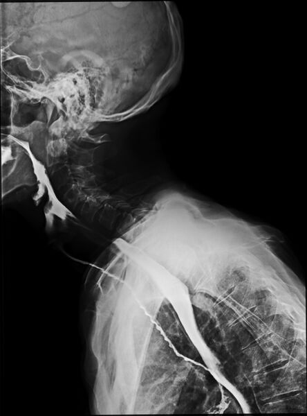 File:Barium swallow aspiration (Radiopaedia 71621-81993 Lateral 1).jpg