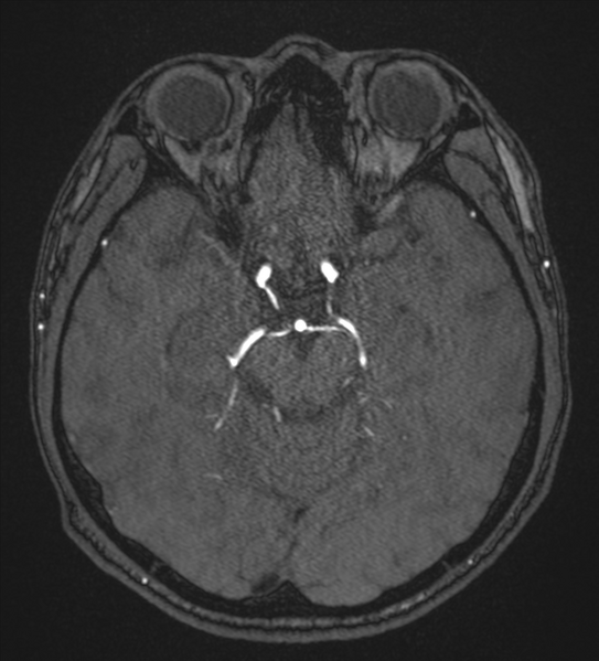 File:Basal ganglia subacute infarct (Radiopaedia 80201-93521 Axial MRA 49).png