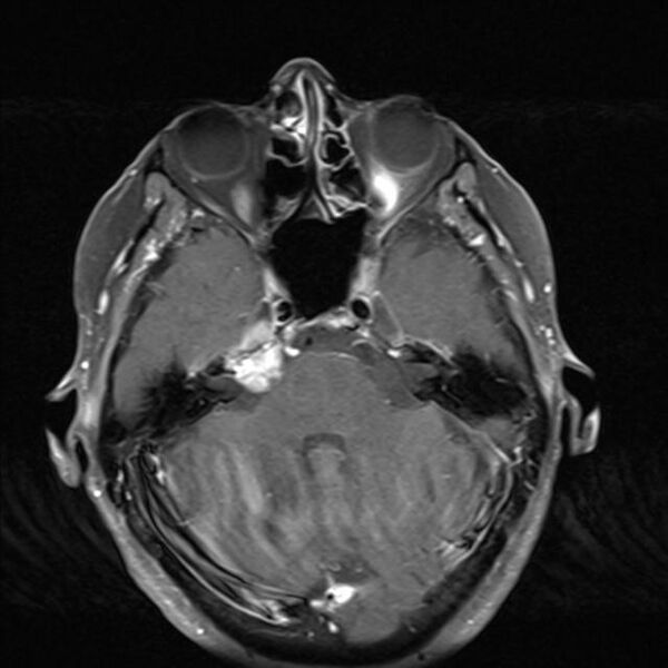 File:Base of skull chondrosarcoma (Radiopaedia 30410-31070 Axial T1 C+ fat sat 12).jpg
