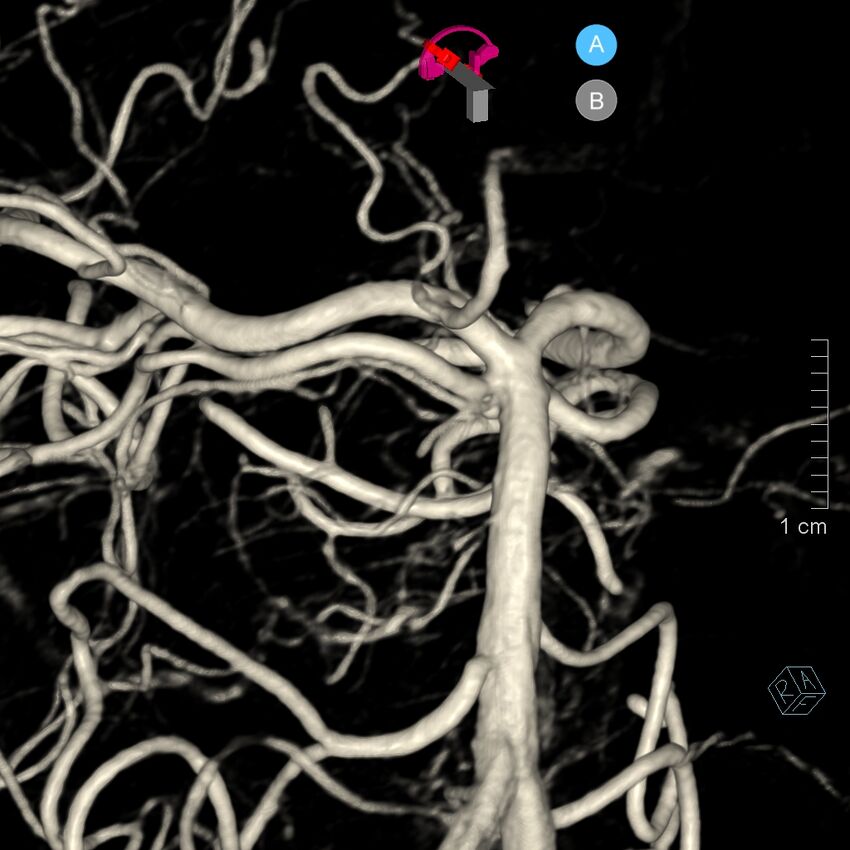 Basilar artery perforator aneurysm (Radiopaedia 82455-97734 3D view left VA 125).jpg