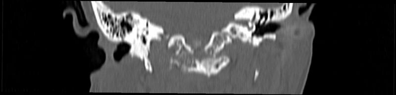 File:Basilar impression (Radiopaedia 52411-58522 Coronal bone window 90).jpg