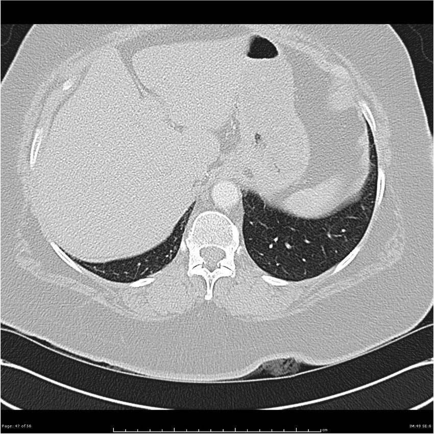 Benign metastasizing leiomyoma (Radiopaedia 26803-26962 Axial lung window 47).jpg
