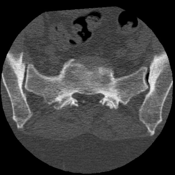 File:Bertolotti syndrome (Radiopaedia 24864-25128 Axial bone window 36).jpg