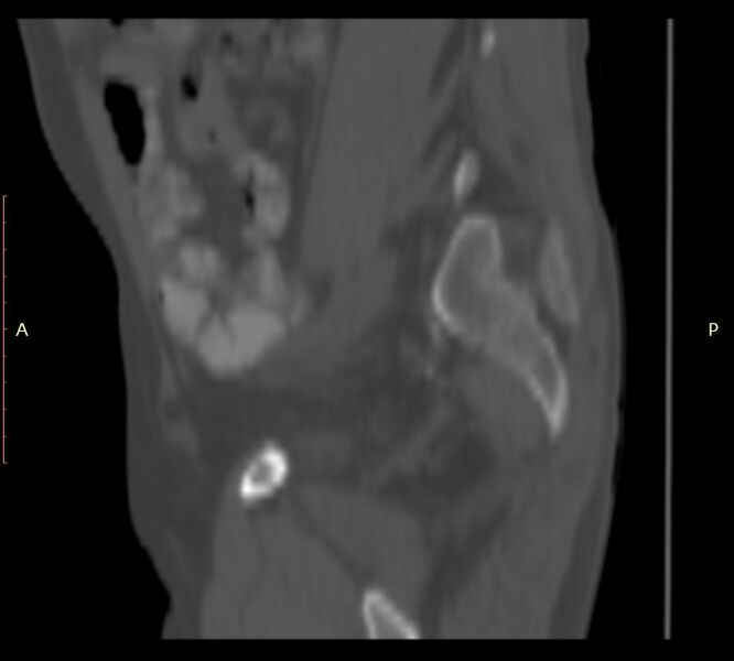 File:Bertolotti syndrome (Radiopaedia 58974-66235 Sagittal bone window 3).jpg