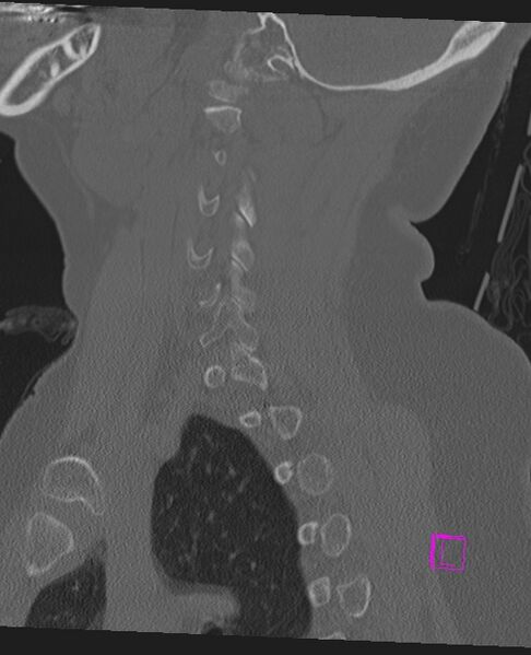 File:Bilateral atlanto-occipital assimilation (Radiopaedia 28350-28603 Sagittal bone window 56).jpg