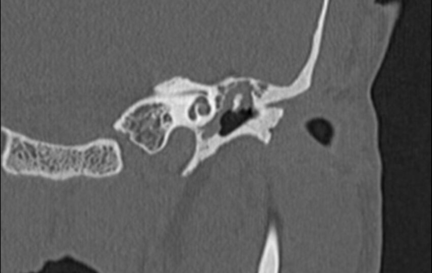 Bilateral cholesteatoma (Radiopaedia 54898-61172 D 8).jpg