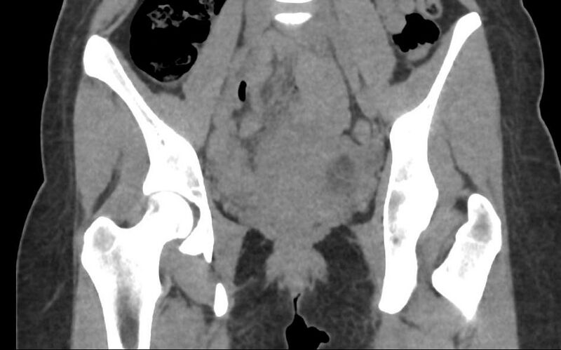 File:Bilateral mature cystic ovarian teratoma (Radiopaedia 88821-105592 Coronal non-contrast 11).jpg