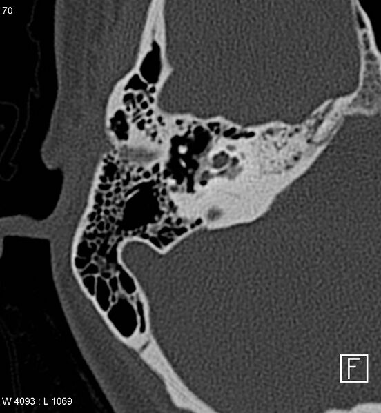 File:Bilateral otosclerosis with left stapes prosthesis (Radiopaedia 5567-7302 Axial bone window 6).jpg