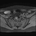Bilateral ovarian endometriomas (Radiopaedia 87085-103347 Axial T1 fat sat 5).jpg