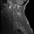 Bilateral perched facets with cord injury (Radiopaedia 45587-49714 Sagittal T1 16).jpg