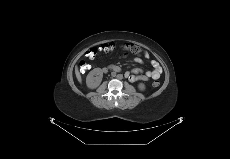 File:Bilateral urolithiasis with incidentally detected splenic artery aneurysm and left inferior vena cava (Radiopaedia 44467-48123 Axial non-contrast 28).jpg