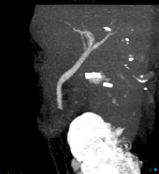 File:Bile leak from accessory duct(s) of Luschka post cholecystectomy (Radiopaedia 40736-43389 D 29).jpg