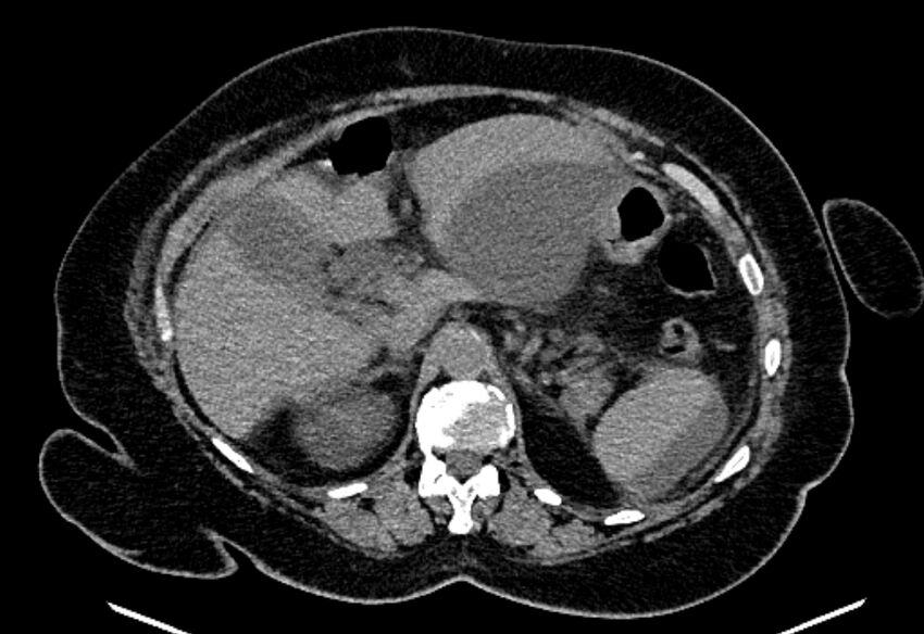 Biliary pancreatitis (Radiopaedia 72289-82823 Axial non-contrast 87).jpg