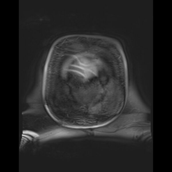 File:Bilobed placenta accreta (Radiopaedia 69648-79591 Coronal T1 vibe 9).jpg