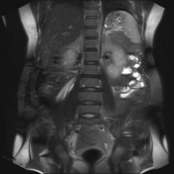 File:Bilobed placenta accreta (Radiopaedia 69648-79591 Coronal T2 fat sat 26).jpg