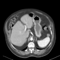 Bladder papillary urothelial carcinoma (Radiopaedia 48119-52951 A 10).png