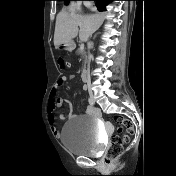 File:Bladder tumor detected on trauma CT (Radiopaedia 51809-57609 E 41).jpg