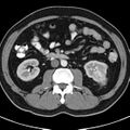 Bosniak cyst - type IV (Radiopaedia 23525-23627 renal cortical phase 34).jpg