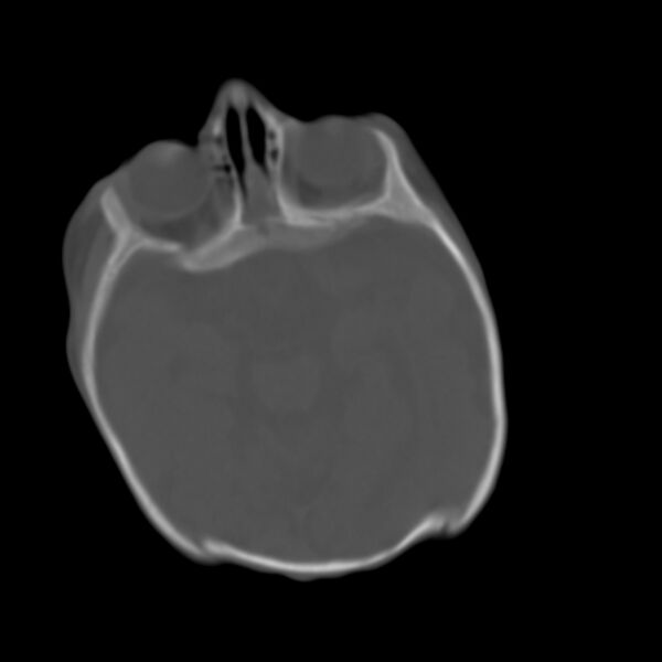 File:Brachycephaly (bi-coronal and bi-lambdoid synostosis) (Radiopaedia 55048-61413 Axial bone window 4).jpg