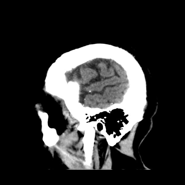 File:Brain Pantopaque remnants (Radiopaedia 78403-91048 C 50).jpg