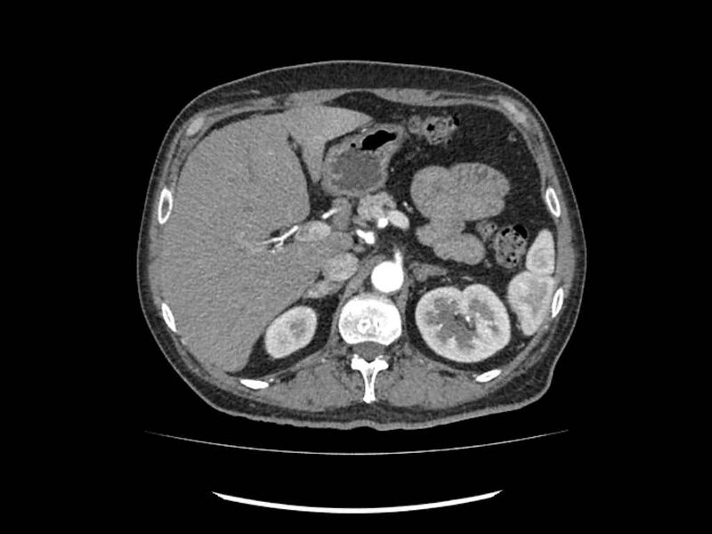 File:Brain metastases from renal cell carcinoma (Radiopaedia 42222-45328 A 36).jpg