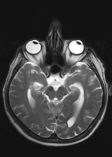 File:Brain metastases from squamocellular lung cancer (Radiopaedia 56515-63222 Axial T2 11).jpg